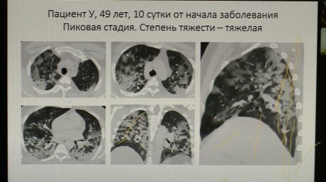 В Пензенской области 569 пациентов с подтвержденным COVID-19
