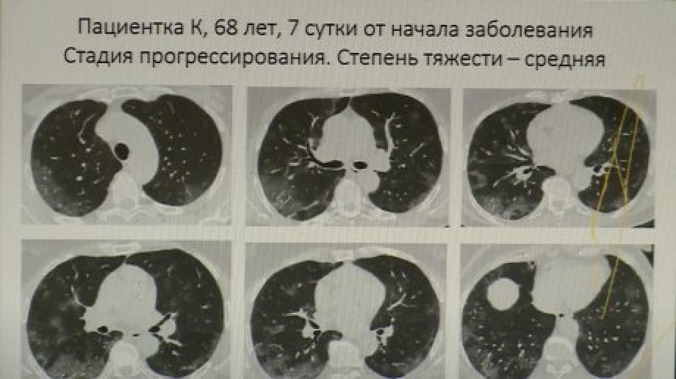 Вячеслав Космачев разъяснил разницу между коронавирусом и пневмонией