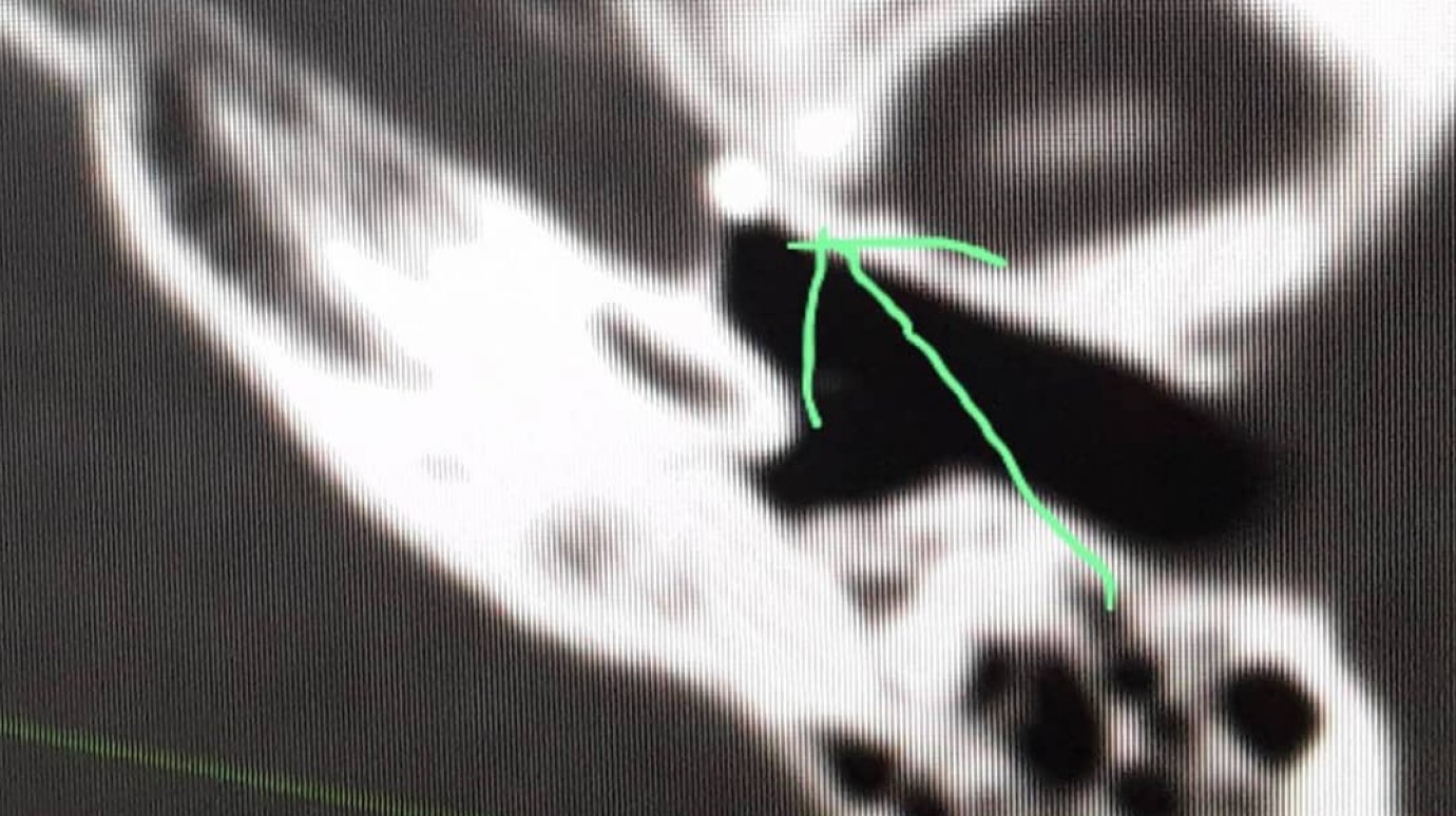 В Пензе врачи нашли за барабанной перепонкой пациента осколки металла