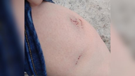 В Пензе женщина пострадала от нападения собаки