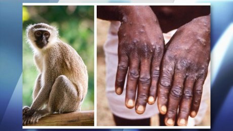 Пензенские медики: обезьяньей оспой можно заразиться за три часа