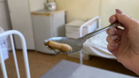 В областной больнице мама нашла в тарелке малыша палец с когтем