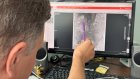 Пензенские врачи провели пациенту сложную пиелопластику