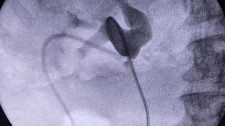 В Пензе впервые провели гибридную урологическую операцию