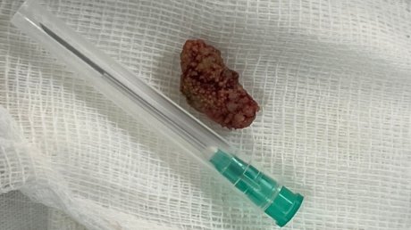 В Пензе впервые провели гибридную урологическую операцию