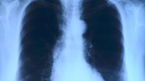 Что нужно знать о туберкулезе каждому
