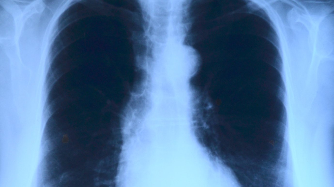 Что нужно знать о туберкулезе каждому